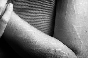 Zelfbeschadiging krassen